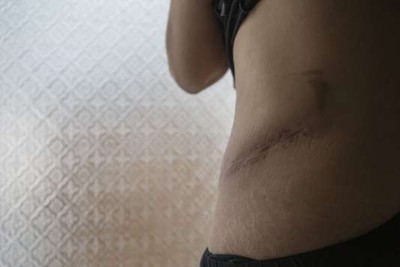 Kalila, réfugiée syrienne de 39 ans, ici au Liban en juin  2014, porte la cicatrice du prélèvement de son rein, vendu 15000 dollars (12600 euros). BILL KOTSATOS / REDUX-REA